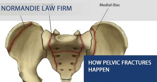 Pelvic fracture injury attorney