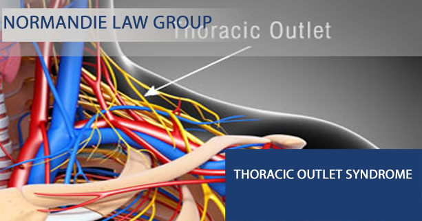 Thoracic outlet syndrome