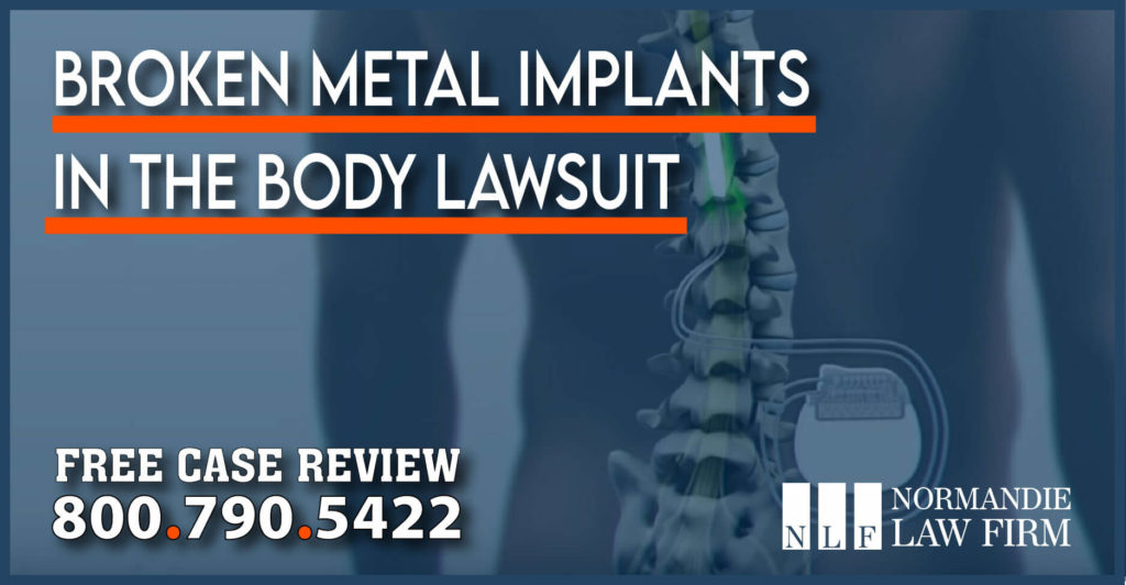 Broken Metal Implants in the Body Lawsuit lawyer attorney sue compensation surgery malpractice
