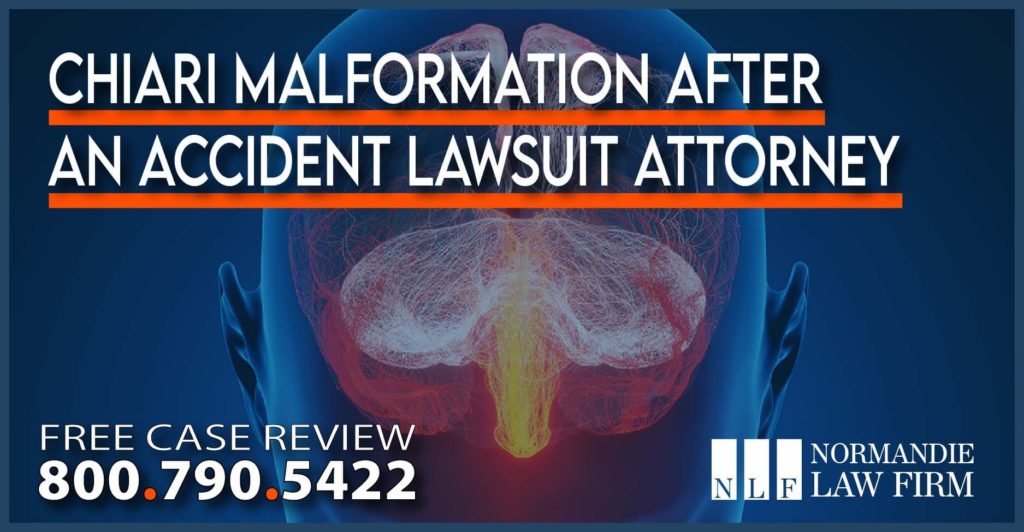 Chiari Malformation after an Accident Lawsuit Attorney lawyer sue lawsuit compensation