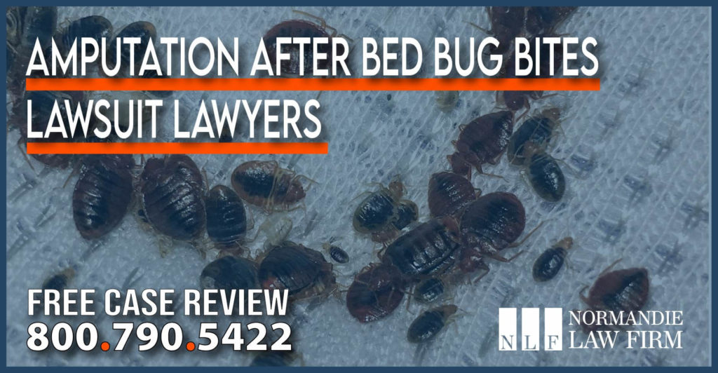 Amputation after Bed Bug Bites Lawsuit Lawyers attorney personal injury liability incident