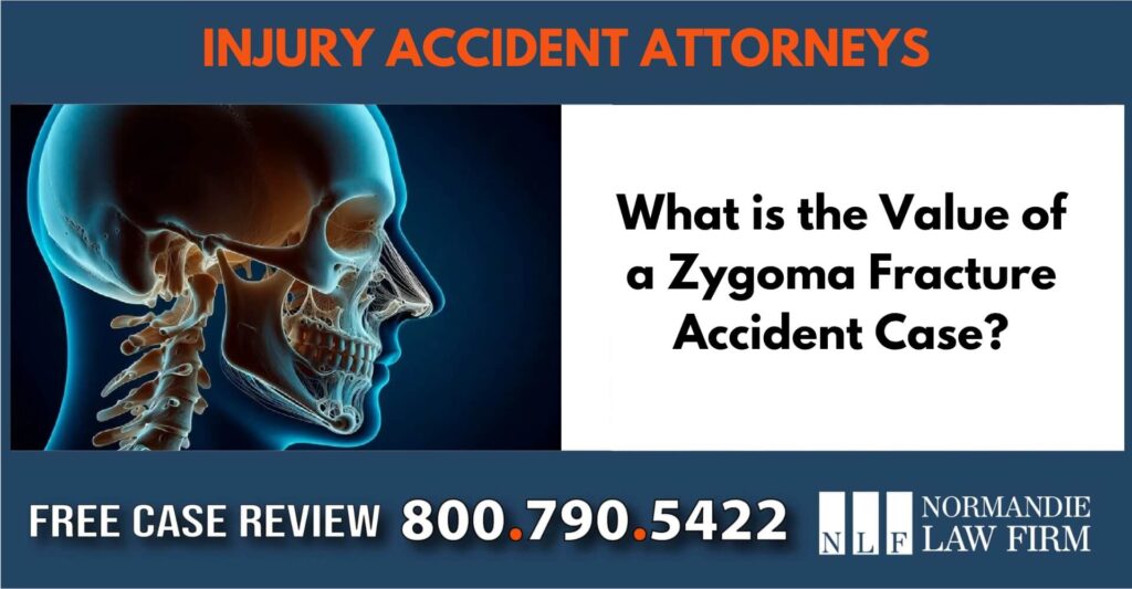 What is the Value of a Zygoma Fracture Accident Case sue liable incident compensation lawyer attorney
